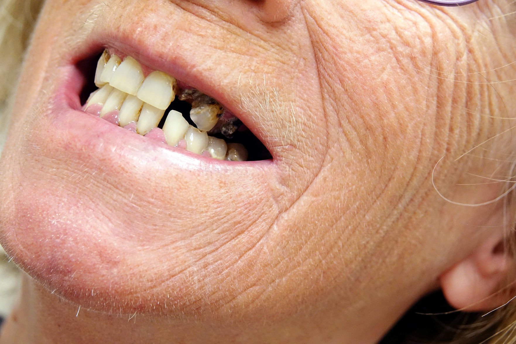 Darlene Gardner relies on treatment from the East Arkansas Family Health Center in Lepanto